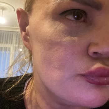 Gözde Herşey - Dr. Semih Doğan Estetik Müdahale Deneyimim