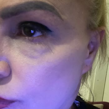 Gözde Herşey - Dr. Semih Doğan Estetik Müdahale Deneyimim