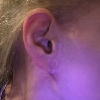 Gözde Herşey - Dr. Semih Doğan Estetik Müdahale Deneyimim