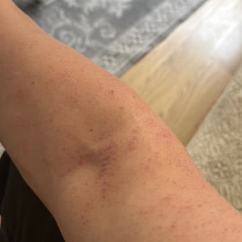 La Beaute By Buse Genç Lazer Epilasyon İşlemi