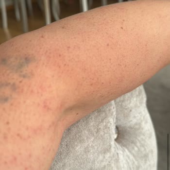 La Beaute By Buse Genç Lazer Epilasyon İşlemi