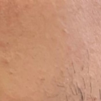 Bezmiâlem Vakıf Üniversitesi Hastanesi Bezmialem Estetik Hatası