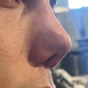 Bezmiâlem Vakıf Üniversitesi Hastanesi Bezmialem Estetik Hatası