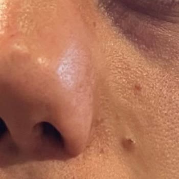 Bezmiâlem Vakıf Üniversitesi Hastanesi Bezmialem Estetik Hatası