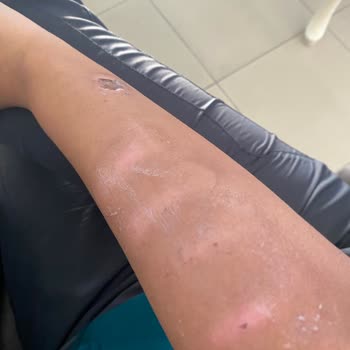 Monalisa Sağlıklı Güzellik Geçmeyen Lazer Yanığı Ve Sonrasında Bilinçsizce Yapılan Hatalar