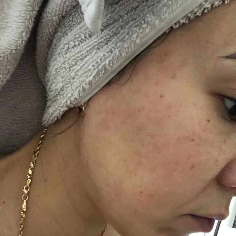 Bioderma Sebium Yüzümde Alerji Yaptı