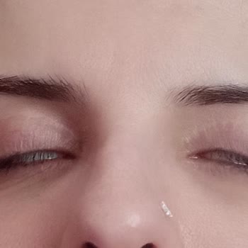 Op. Dr. Ömer Keven Ameliyat Sonrası Gözlerim Tam Olarak Kapanmıyor