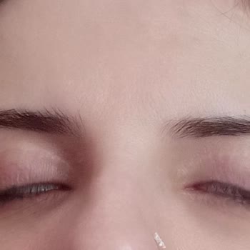 Op. Dr. Ömer Keven Ameliyat Sonrası Gözlerim Tam Olarak Kapanmıyor