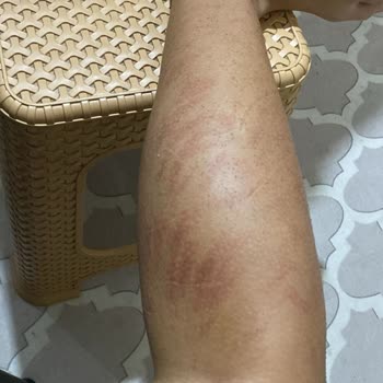 Kübra İyisan & Selda Çelik Güzellik Salonu Lazer Yanığı