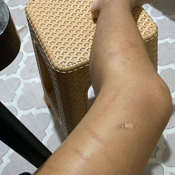 Kübra İyisan & Selda Çelik Güzellik Salonu Lazer Yanığı