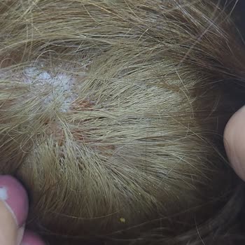 Garnier Saç Boyası Saç Derimi Komple Yaktı Açıdan Duramıyorum