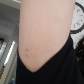 Aris Güzellik Merkezleri Bursa Güzellik Merkezinde İğneli Epilasyon Deneyimi