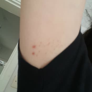 Aris Güzellik Merkezleri Bursa Güzellik Merkezinde İğneli Epilasyon Deneyimi