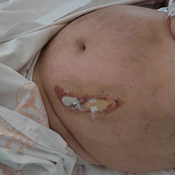 Gisbir Hastanesi Yoğun Bakımda Hastamızı Yaktılar