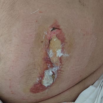 Gisbir Hastanesi Yoğun Bakımda Hastamızı Yaktılar