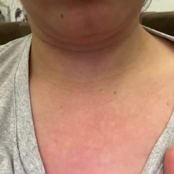 Selfit Vitamin Çok Kötü Alerji Yaptı Hiç Muhatap Bulamıyorum