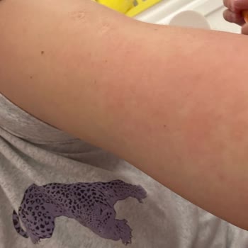 Selfit Vitamin Çok Kötü Alerji Yaptı Hiç Muhatap Bulamıyorum