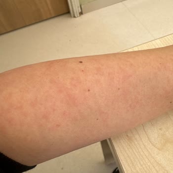 Selfit Vitamin Çok Kötü Alerji Yaptı Hiç Muhatap Bulamıyorum