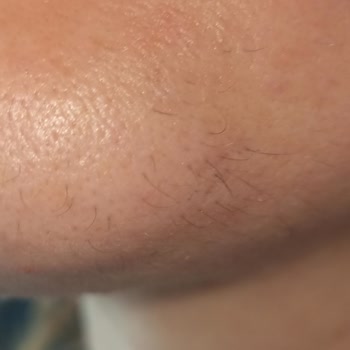 Sandra Güzellik ve Epilasyon Salonu Yüz Epilasyon İçin Gittiğim Sandra Güzellik Merkezinden Şikayetçiyim