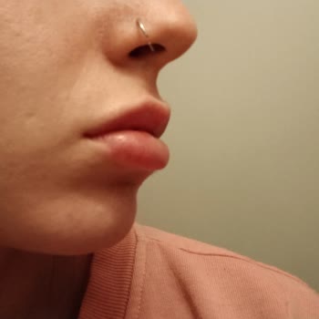 Medicaderma Üsküdar Dudak Dolgusu