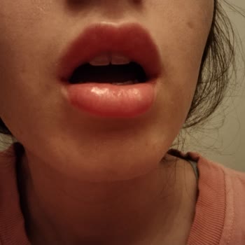 Medicaderma Üsküdar Dudak Dolgusu