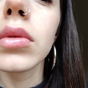 Medicaderma Üsküdar Dudak Dolgusu