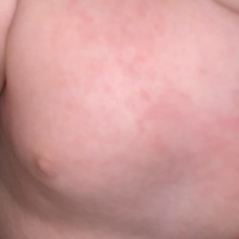 Mustela Güneş Kremi Şikayeti