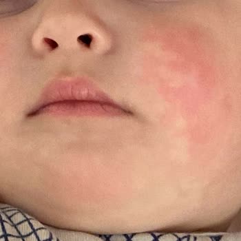 Mustela Güneş Kremi Şikayeti