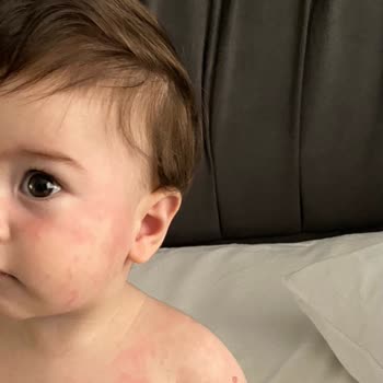 Mustela Güneş Kremi Şikayeti