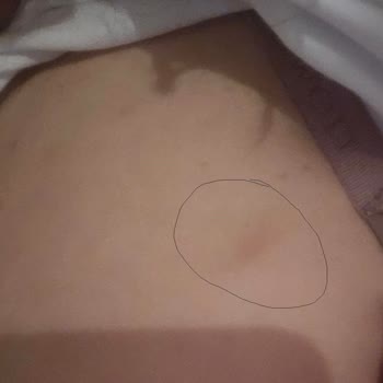 Suwen Sutyen Askısının Cilde Verdiği Hasar