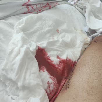 Muğla Sıtkı Koçman Üniversitesi Eğitim ve Araştırma Hastanesi Femur Kırığı Ve Enfeksiyon.