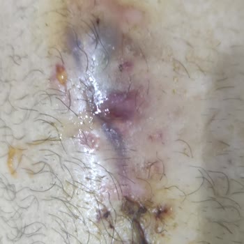 Muğla Sıtkı Koçman Üniversitesi Eğitim ve Araştırma Hastanesi Femur Kırığı Ve Enfeksiyon.