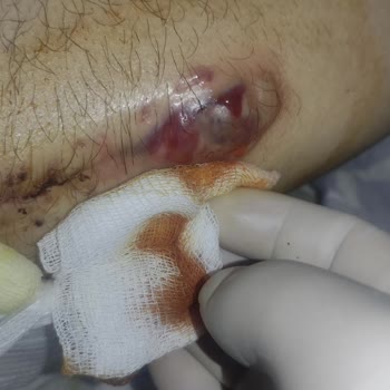 Muğla Sıtkı Koçman Üniversitesi Eğitim ve Araştırma Hastanesi Femur Kırığı Ve Enfeksiyon.