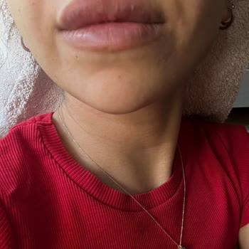 Luvimed Clinic Dudak Dolgusu İşlemi