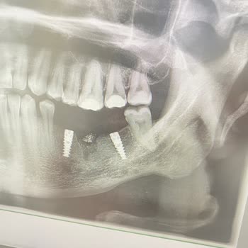 Medigma Biomedical İmplant Memnuniyetsizliği