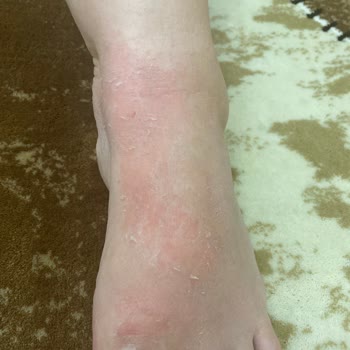 Gratis Bealius Marka Ayak Maskesinden Şikayet