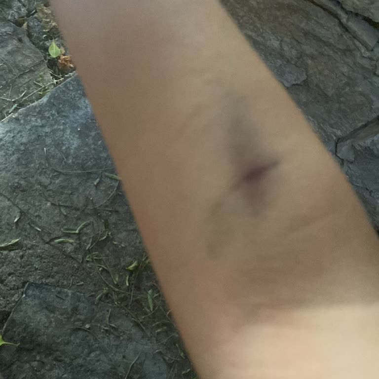 Bodrum Devlet Hastanesi Serumdan Sonra Kolda Morarma