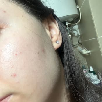 Yves Rocher Cilt Sağlığımla Oynadı