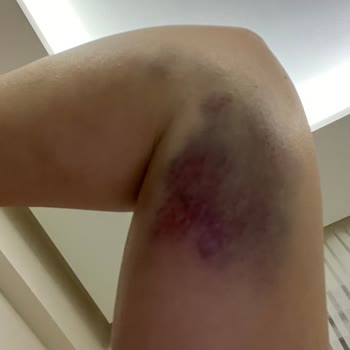 Medicana Hastanesinde Damar Yolu Açan Hemşirenin İhmali Sonucu.