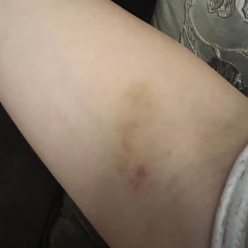 Medicana Hastanesinde Damar Yolu Açan Hemşirenin İhmali Sonucu.