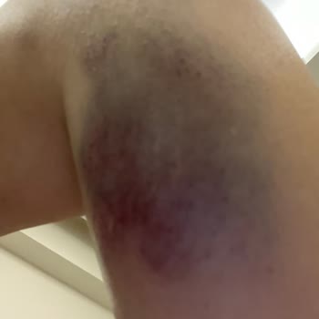 Medicana Hastanesinde Damar Yolu Açan Hemşirenin İhmali Sonucu.