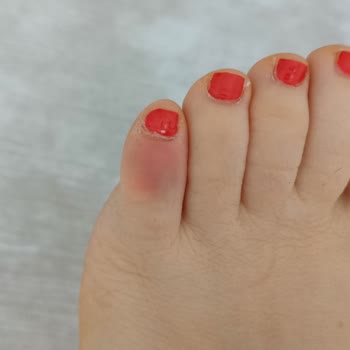 Birkenstock Terlikler Ayağımı Yara Yaptı