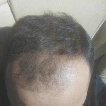 Dissatisfied with Hair Transplant Results and Follow-Up at Estetik International Bursa
