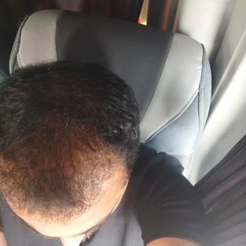 Dissatisfied with Hair Transplant Results and Follow-Up at Estetik International Bursa