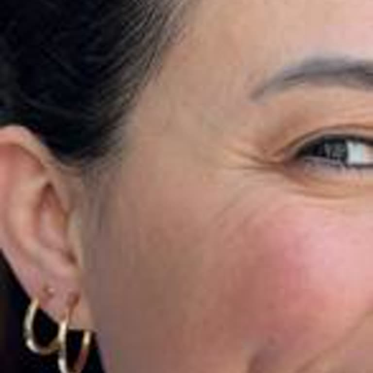 Nişantaşı British Esthetic Sulu Botoks Enjekte Ediliyor.