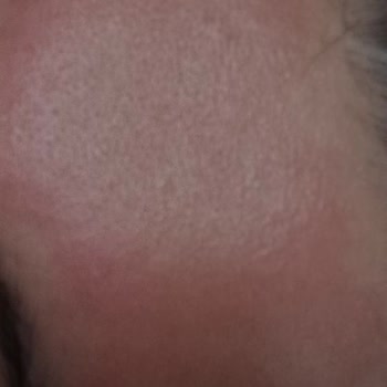 Nivea Peeling Yüzümü Yaktı