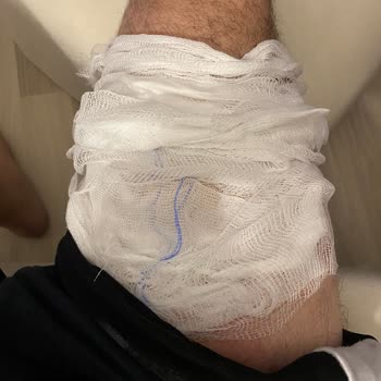 Homend Kettle Nedeniyle Yanmam