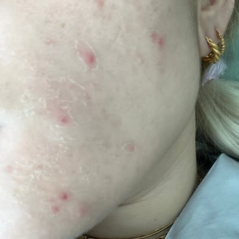 Kiperin Kolajen Sivilce Sorunu