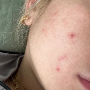 Kiperin Kolajen Sivilce Sorunu