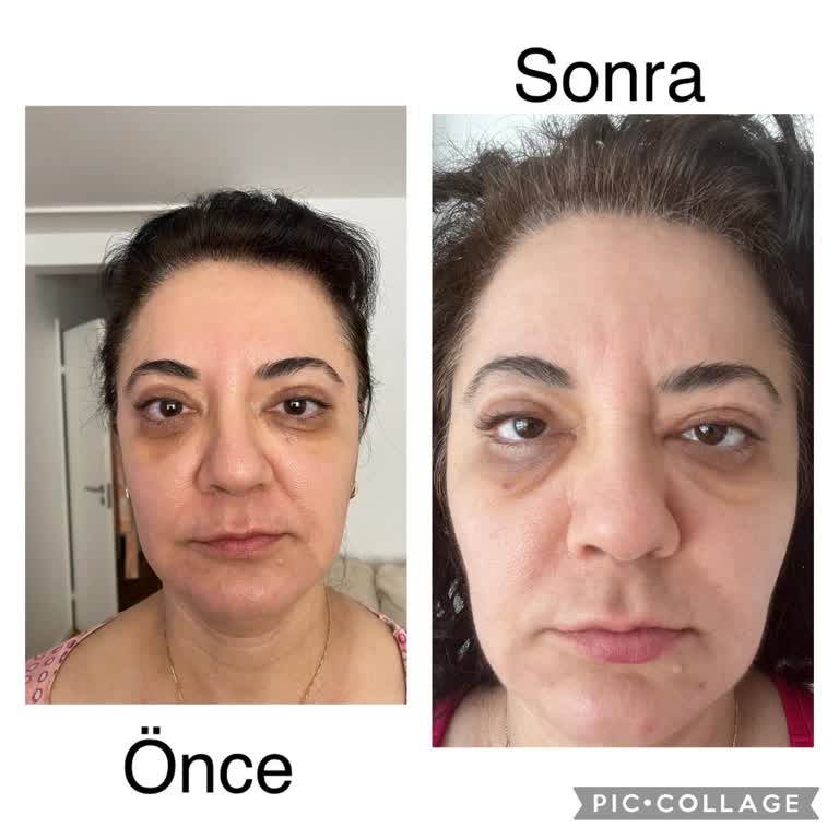 Estpoint Estelift Güzellik Merkezi